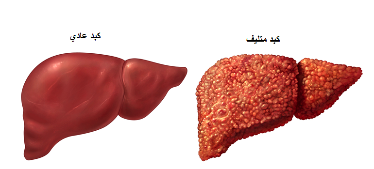 الإلتهاب الكبدي الوبائي - يعنى 