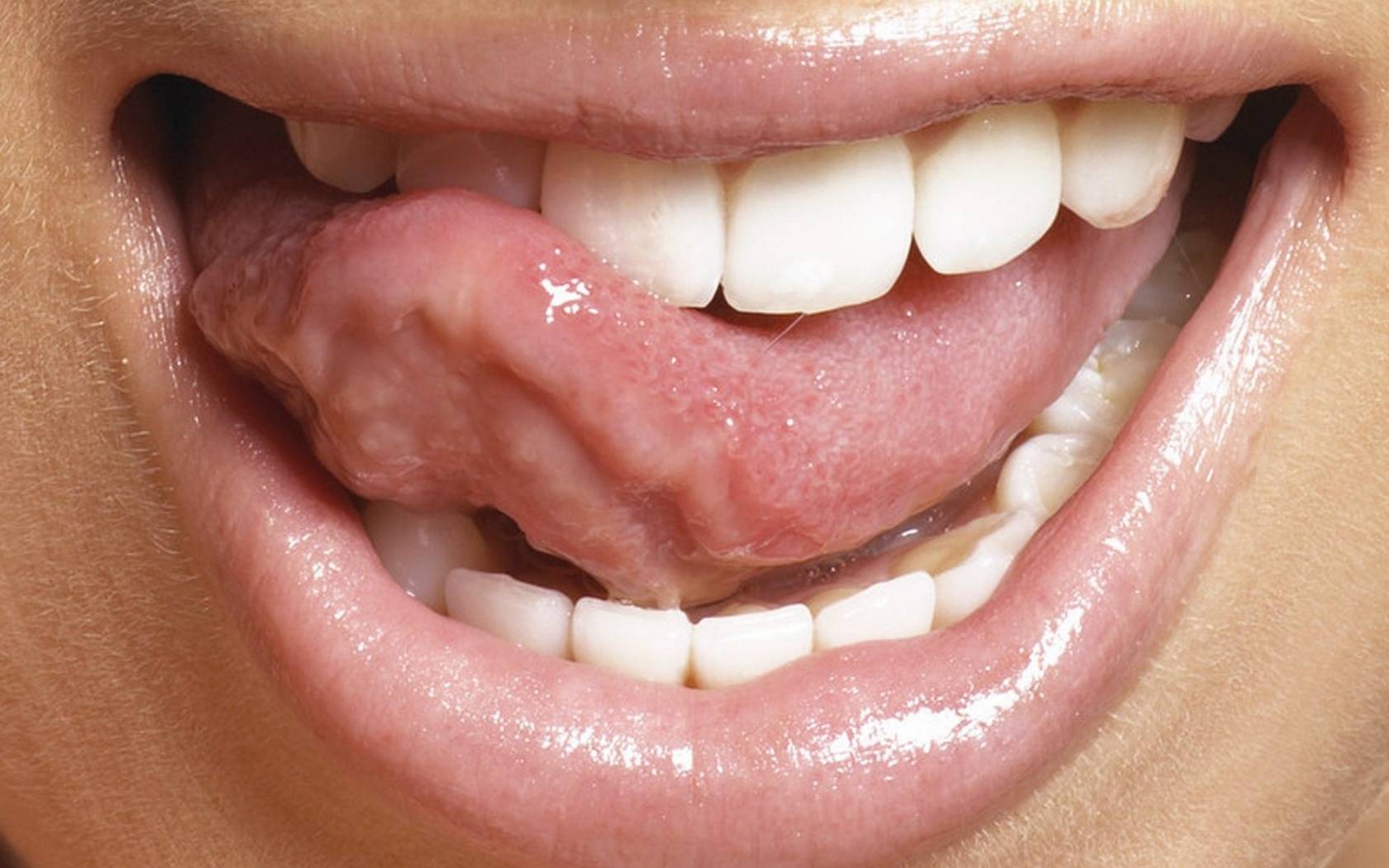 علاج حبوب اللسان - يعنى 